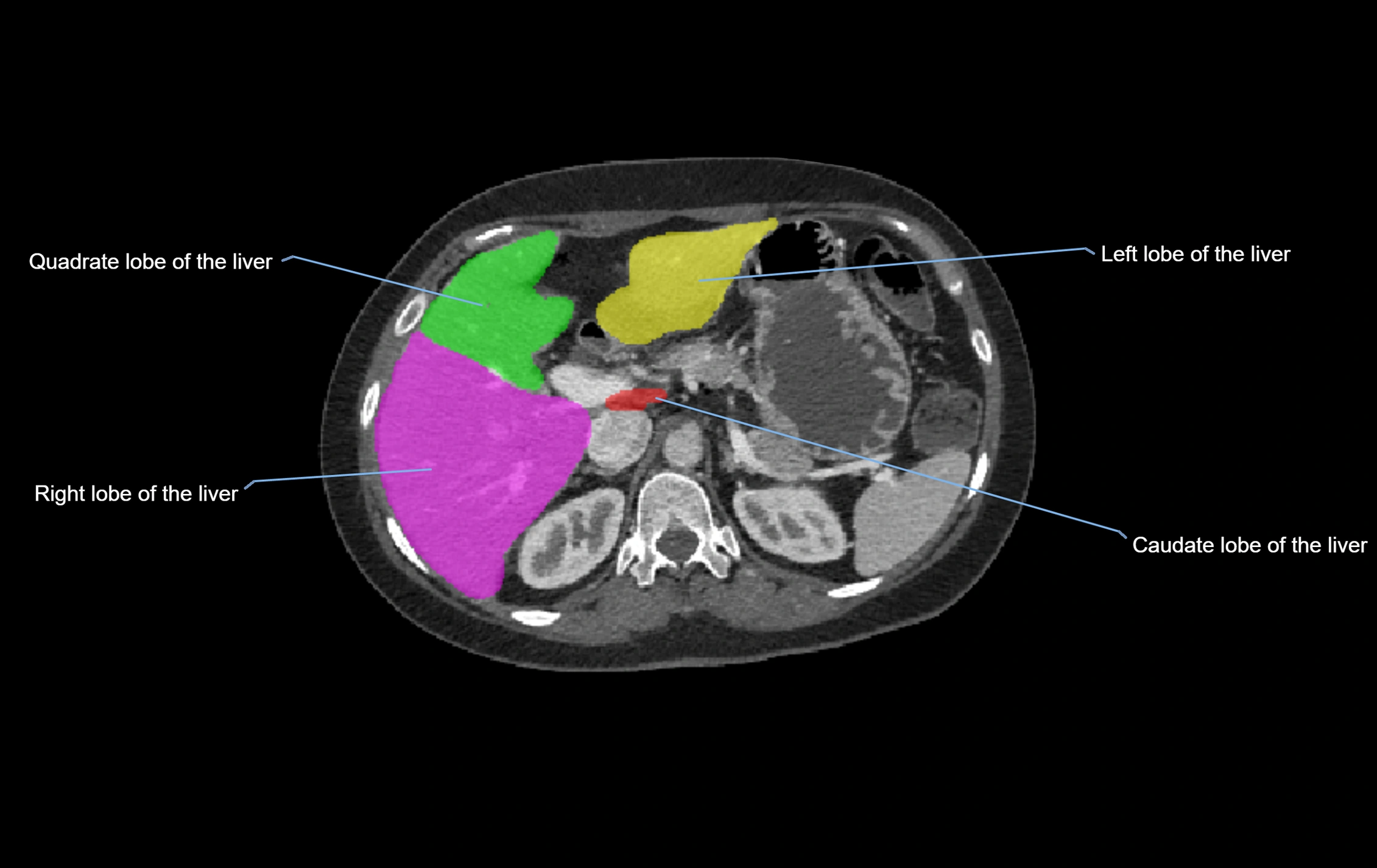 CT lliver lobes axial cross sectional anatomy labelled image -00044.webp